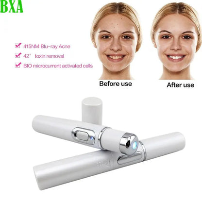 1PCS Blue Light Acne Pen Eye Massager Anti-Pouch Black Heating Eye Massager Stick Eye Beautifying Instrument (White)