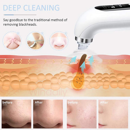 NEW Blackhead Removal Hole Vacuum Cleaner Electric Tiny Bubble Cleanser USB Rechargeable Beauty Device