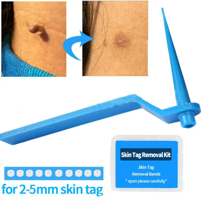 1set Skin Tag Kill Skin Mole Wart Removal Micro Skin Tag Removal Kit with Cleansing Swab Adult Mole Wart Facial Treatment